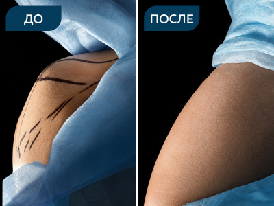 Липосакция под местной анестезией