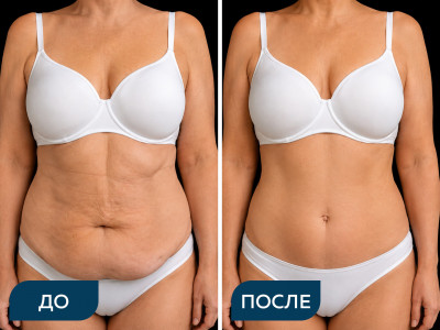 Классическая абдоминопластика с липосакцией передней брюшной стенки