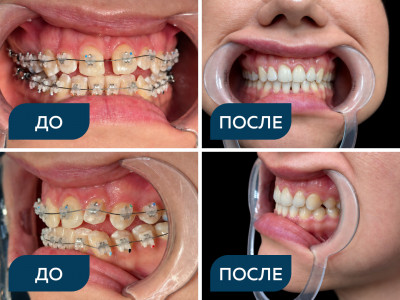 Комплексное ортодонтическое лечение