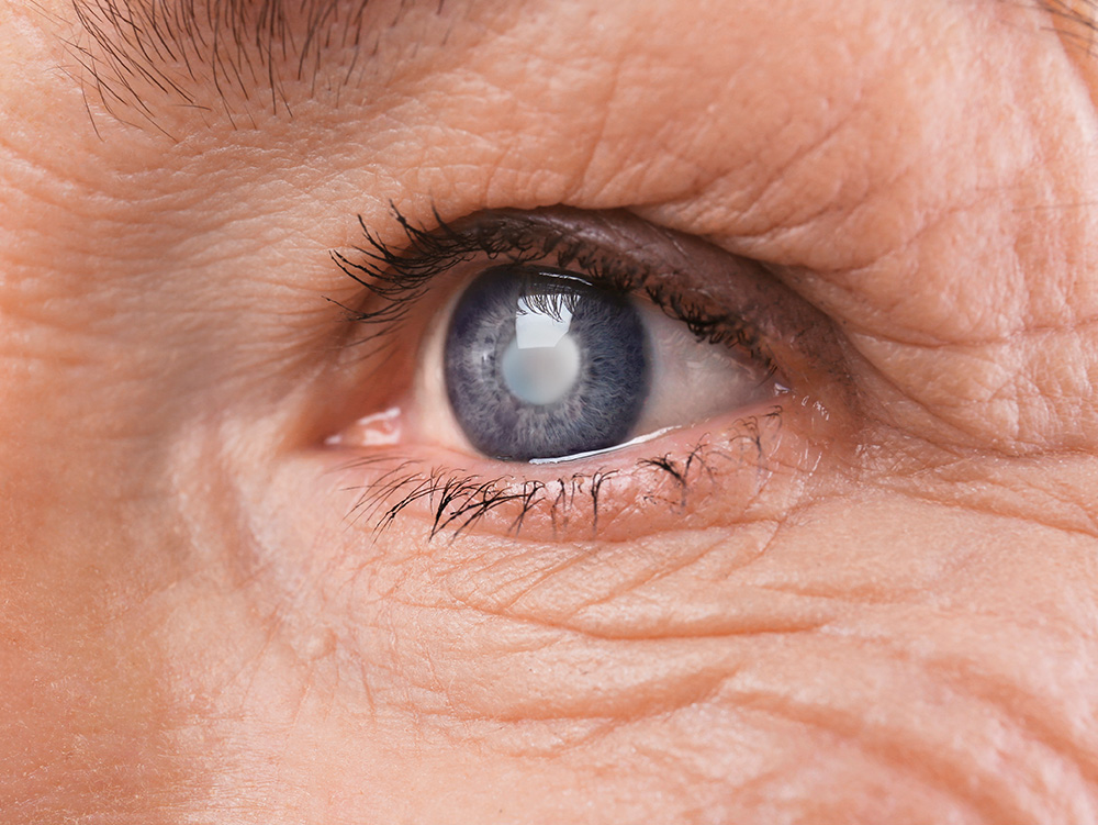 Золотой стандарт" лечения катаракты – Факоэмульсификация с имплантацией ИОЛ