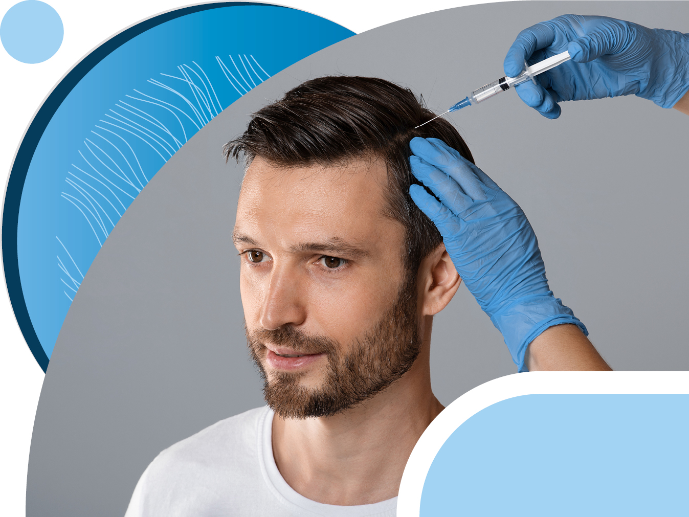 Процедура плазмотерапии после проведения трансплантации волос на голове — БЕСПЛАТНО