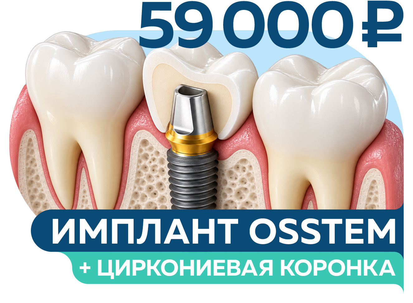 Имплантация под ключ: имплант OSSTEM + циркониевая коронка за 59 000 руб.