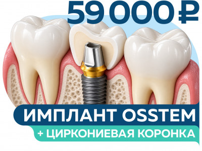 Имплантация под ключ: имплант OSSTEM + циркониевая коронка за 59 000 руб.
