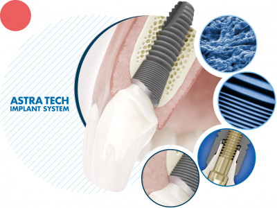 Всё включено: имплант Astra Tech + циркониевая коронка за 95 000 руб.!