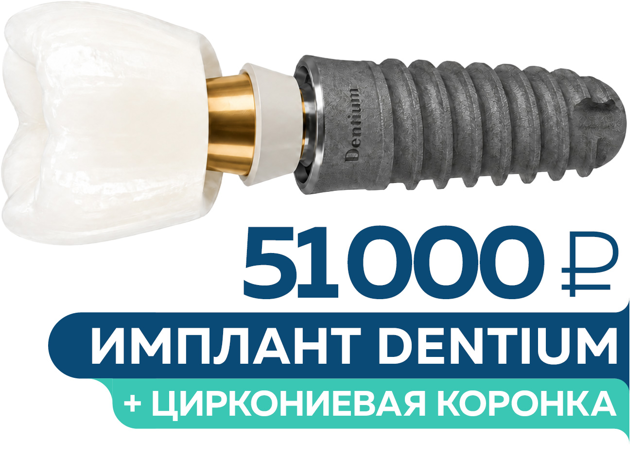 Имплантация Dentium под ключ – 51 000 руб.
