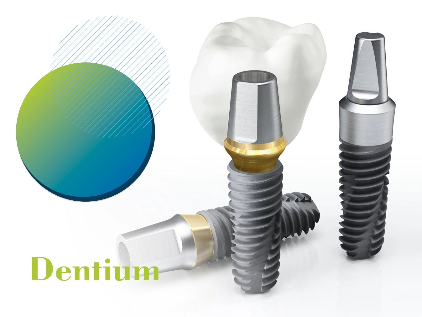 Имплантация Dentium под ключ – 51 000 руб.