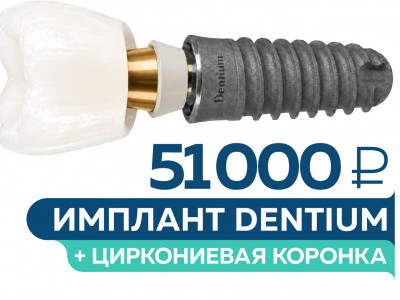 Имплантация Dentium под ключ – 51 000 руб.