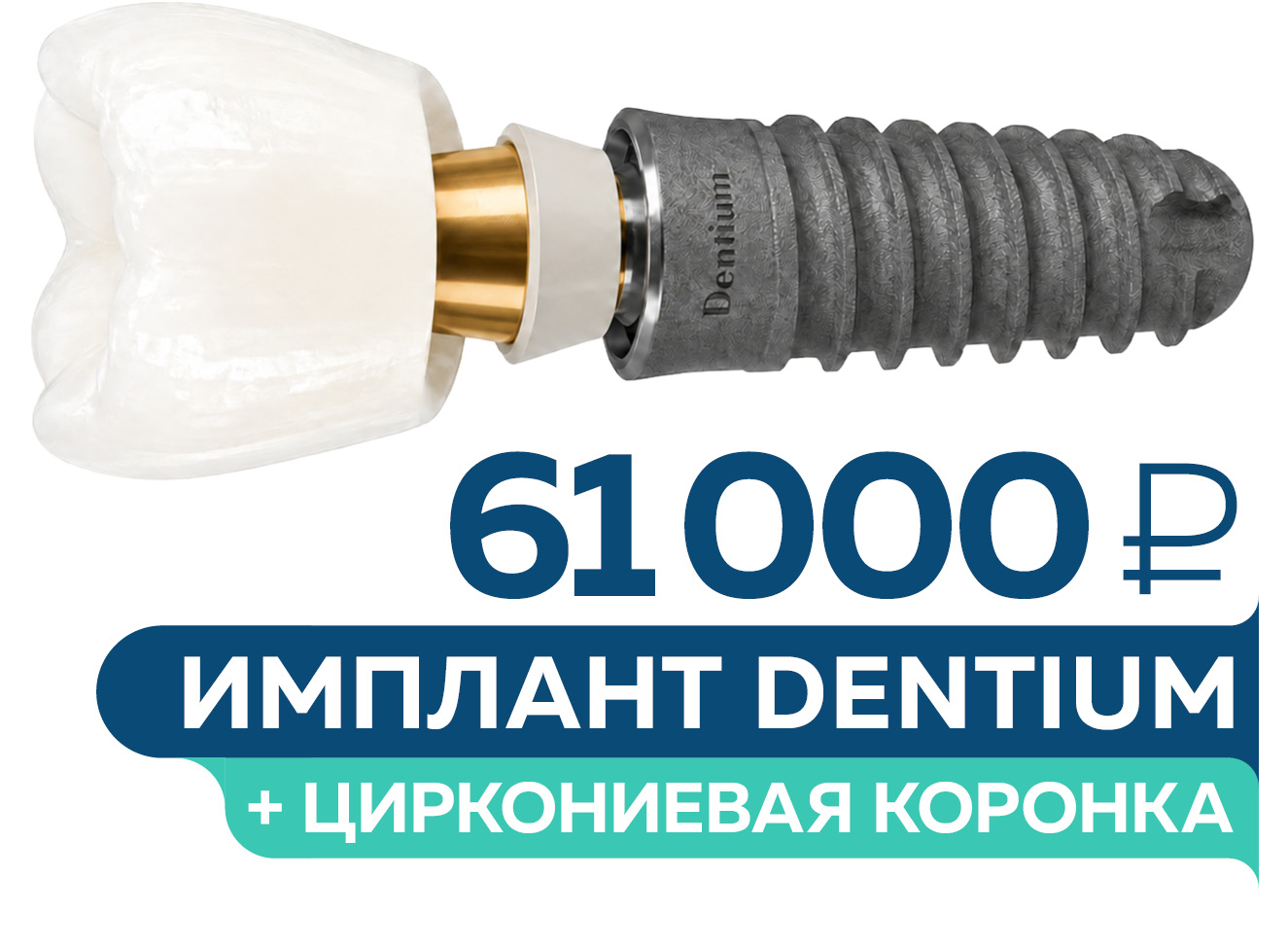 Имплантация Dentium под ключ – 61 000 руб.
