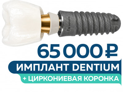 Имплантация Dentium под ключ – 65 000 руб.