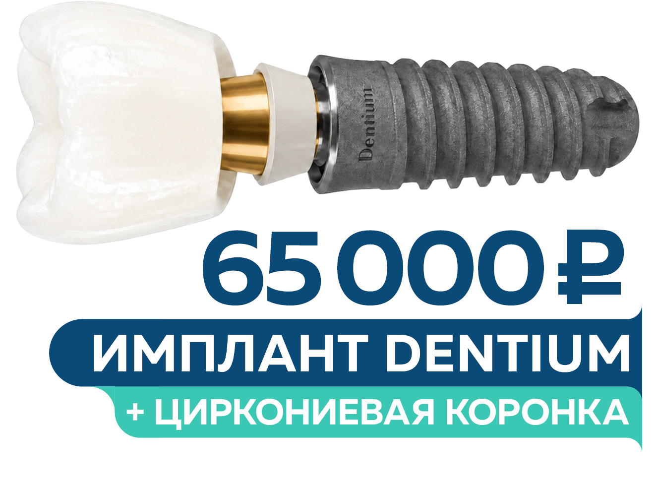 Имплантация Dentium под ключ – 65 000 руб.