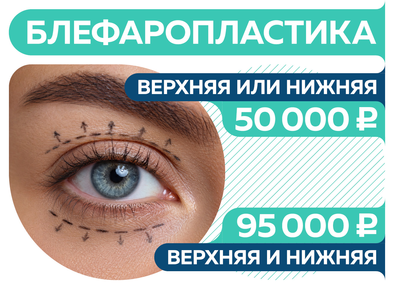 Блефаропластика по акционной цене