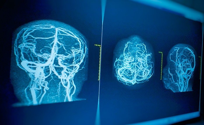 КТ-ангиография артерий головного мозга на Бабушкинской в Москве в клинике Столица