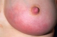 Лечение послеродового мастита в Москве Лечение послеродового мастита в Москве